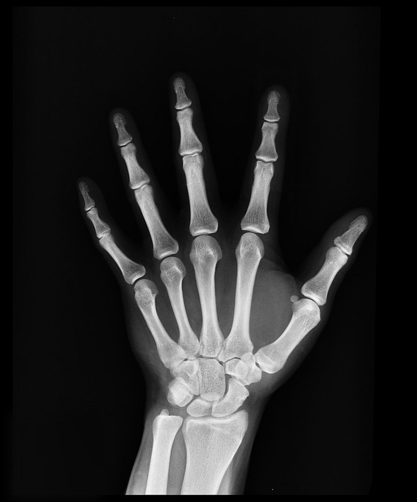 x-ray, medical treatment, arm